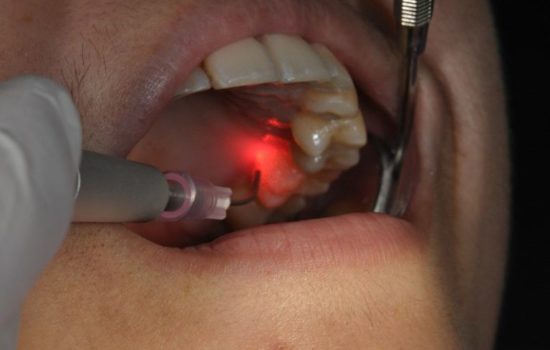 Laser Dental Treatment